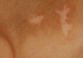 哪些白癜風(fēng)患者適合手術(shù)治療