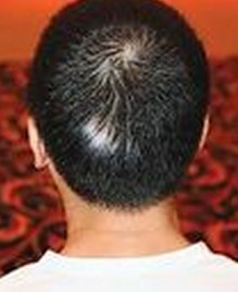 頭部白癜風(fēng)會不會蔓延到臉上