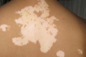 白癜風是一下變白還是慢慢變白