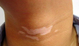 如何防治頸部白斑擴散至臉部