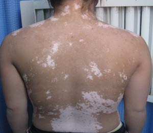 偏方治療白癜風明顯嗎