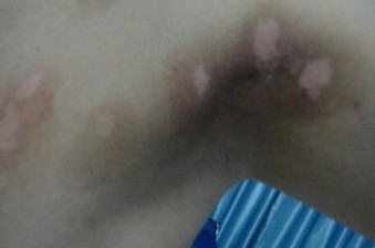 夏天如何避免白癜風的擴散