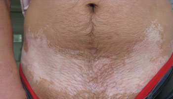 腰上大面積白癜風(fēng)還能治好嗎