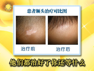 <strong>頭部白癜風患者該怎么洗發</strong>