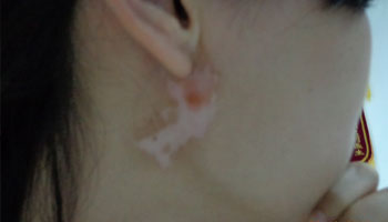 患上白癜風要做哪些檢查