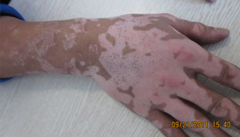 白癜風治療總是不見黑色素出現(xiàn)怎么回事