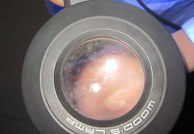 無色素痣和白癜風白斑應該怎樣區分