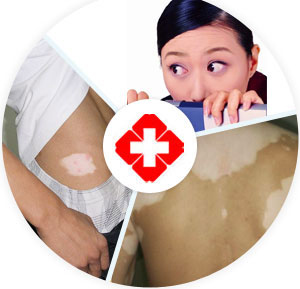 治療小孩白癜風(fēng)怎么好的比較快