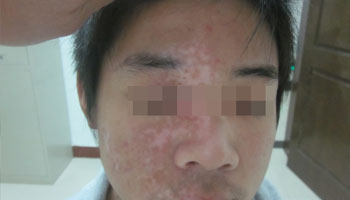 白癜風的白斑發病后就擴散很快怎么辦