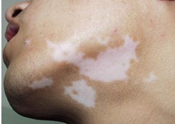 白癜風沒有自覺癥狀可以不治嗎