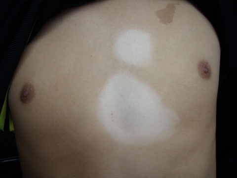 白癜風怎么治療效果好