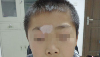 白癜風病情輕重