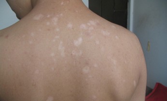 背部白癜風(fēng)又復(fù)發(fā)了怎么辦