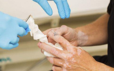 308激光照白癜風(fēng)起水泡能弄破嗎