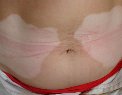 如何有效避免白癜風(fēng)的白斑擴(kuò)散