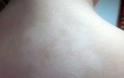 尋常型白癜風