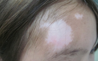 兒童白癜風(fēng)到底能否 治好