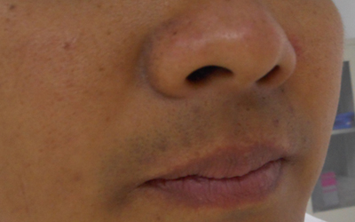 白癜風兒童患者都具備哪些癥狀表現呢