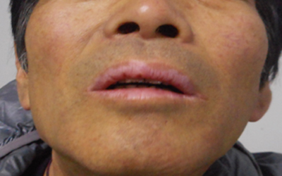 兒童面部白癜風(fēng)病因和治療方法