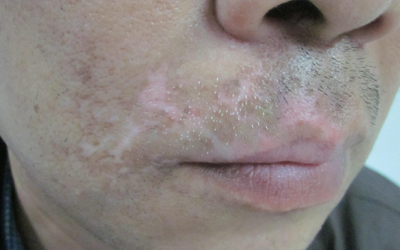 兒童患有白癜風的原因是什么