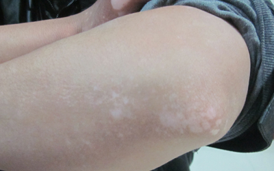 嬰兒有白癜風可以用補骨脂泡酒嗎