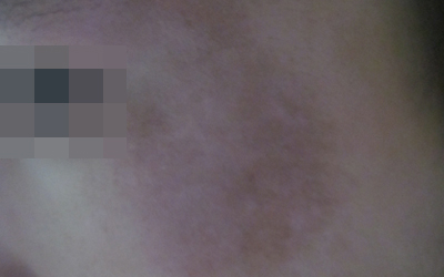 兒童得了白癜風要注意哪些事項