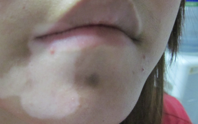 兩歲小孩肚子上一小塊淺白色是什么原因