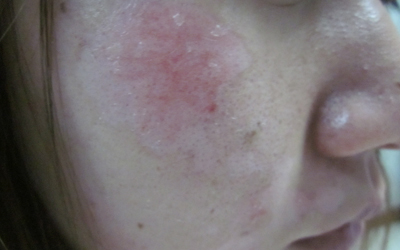 兒童胳膊上白癜風不斷擴散怎么辦