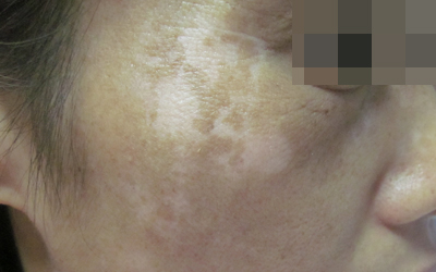 兒童白癜風患者飯后”五不宜”