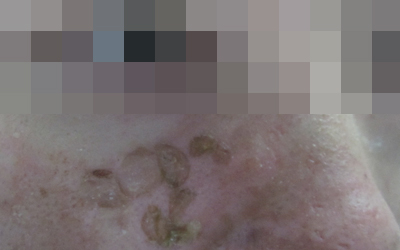 兒童白癜風照308幾次能好