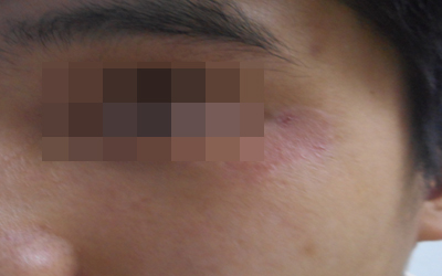 兒童白癜風的發病原因都有哪些呢