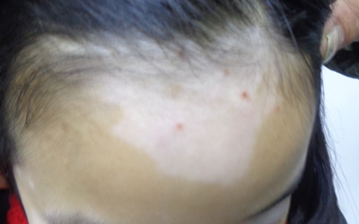 幼兒白癜風(fēng)可以外用補(bǔ)骨脂嗎