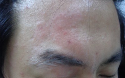 小孩臉上白斑是缺少什么