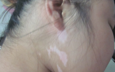 兒子得了白癜風治療用什么方法好