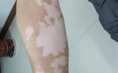 兒童白癜風患者的護理措施都是什么