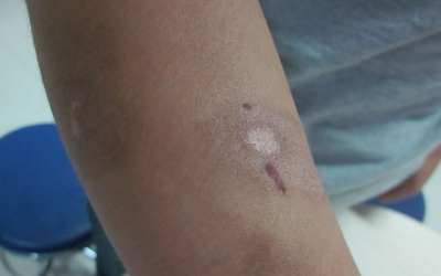 兒童早期白癜風的癥狀有哪些