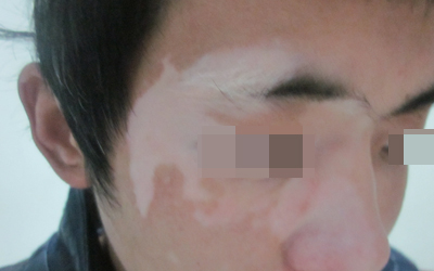 兒童白癜風是如何發展與治療的