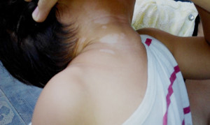 兒童白癜風初期白斑癥狀圖