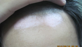 小孩頭部大面積白癜風照308能好嗎