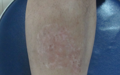 小孩子腿上有一小塊白是白癜風