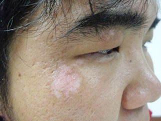 男性面部白癜風