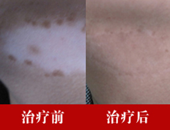 邯鄲白癜風醫院咋掛號