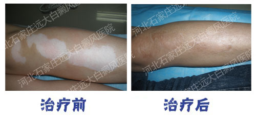 治好腿上白斑——就來石家莊遠大白癜風醫院