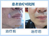 8歲男孩面部白癜風在遠大治好