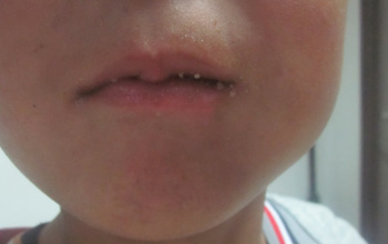 兒童面部白癜風