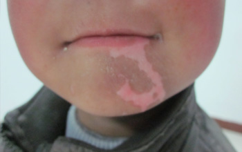 兒童面部白癜風