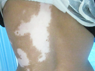 30年白癜風終在遠大治好