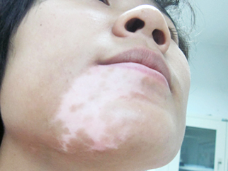 陳小姐 ，面部白斑1年多