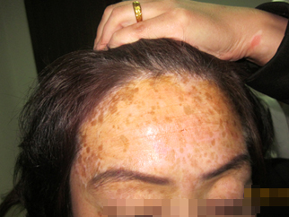 王女士額頭白癜風30年治好