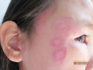 5年白癜風終于治好，父母感激涕零